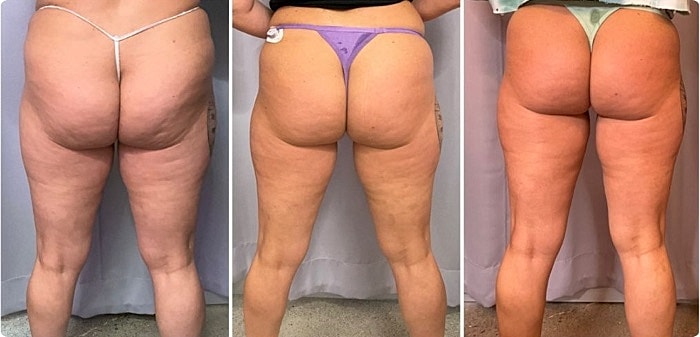 T Shape Before & After