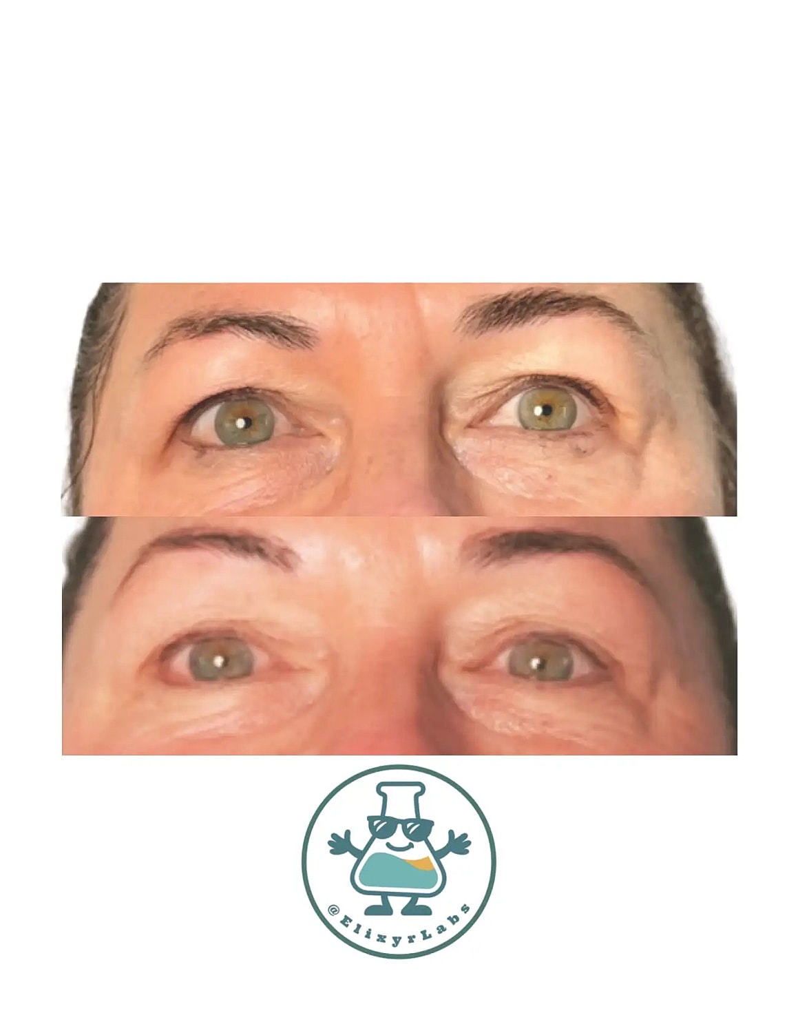 T Shape Before & After