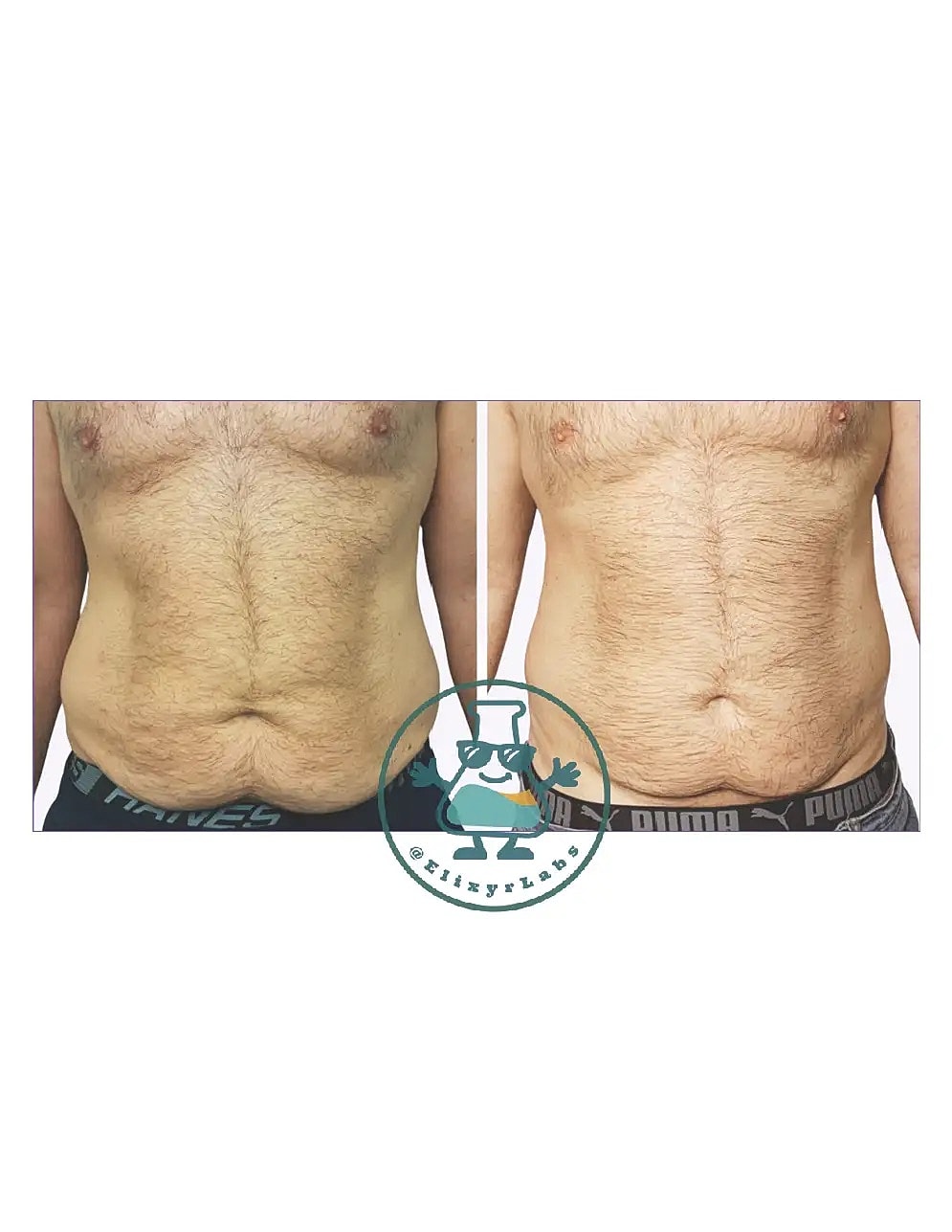 T Shape Before & After