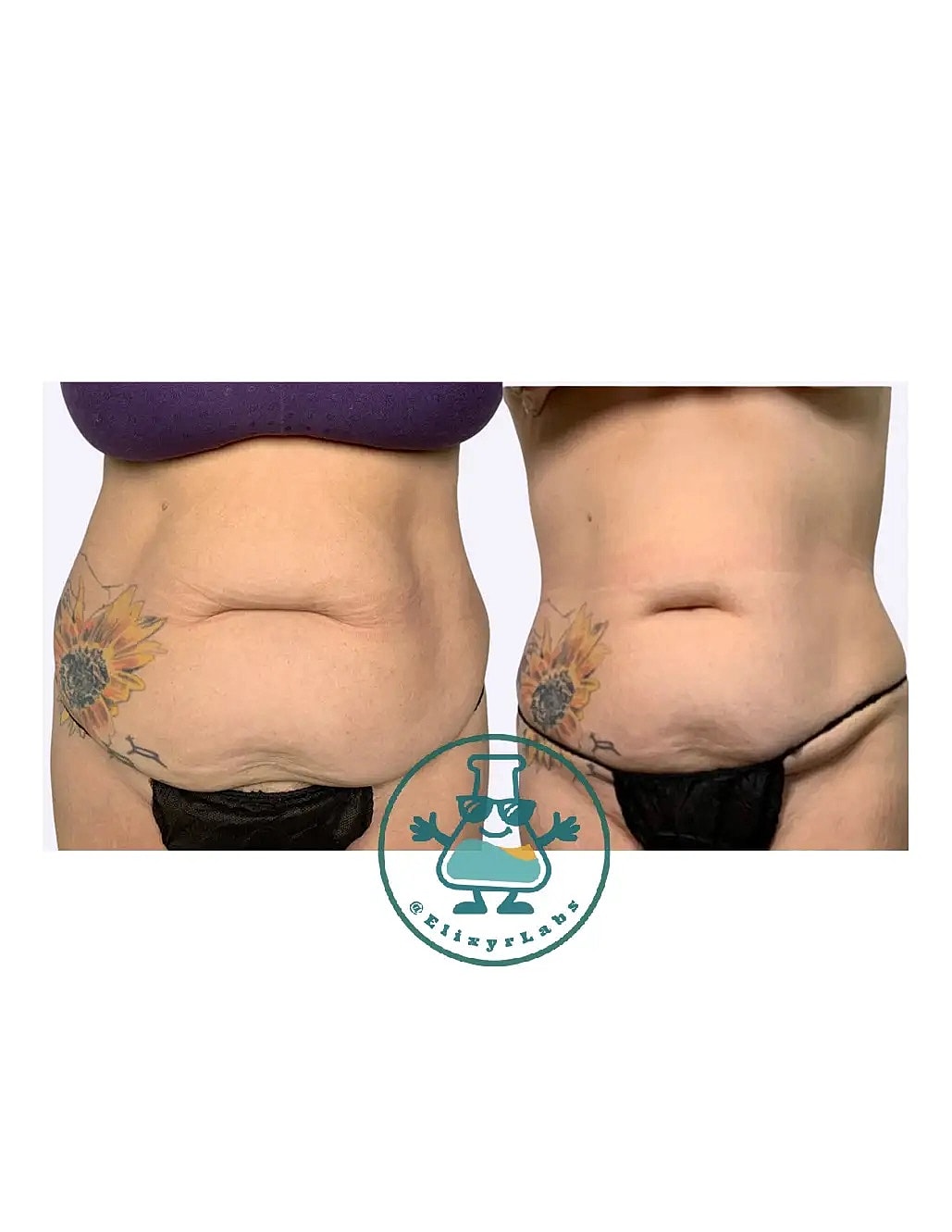 T Shape Before & After