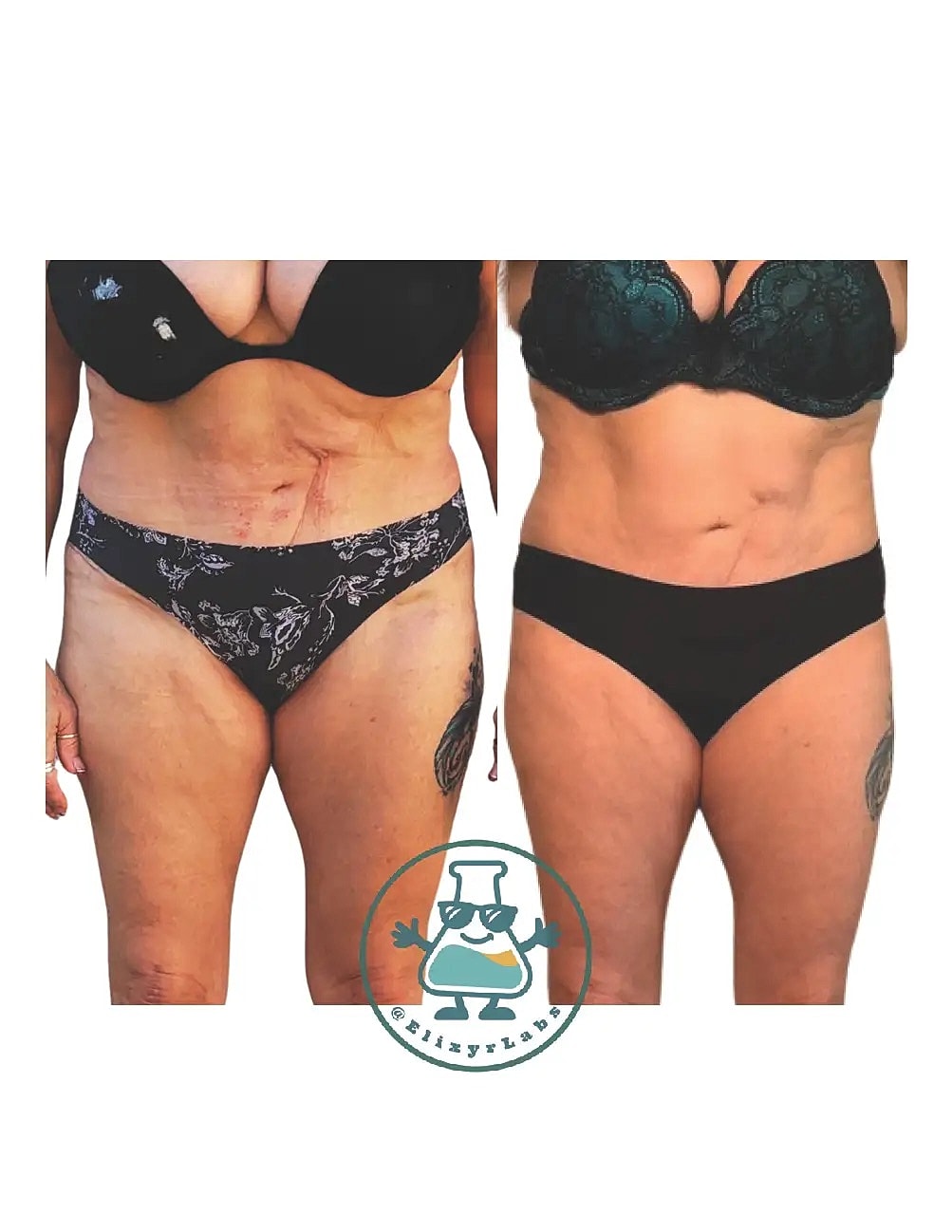 T Shape Before & After