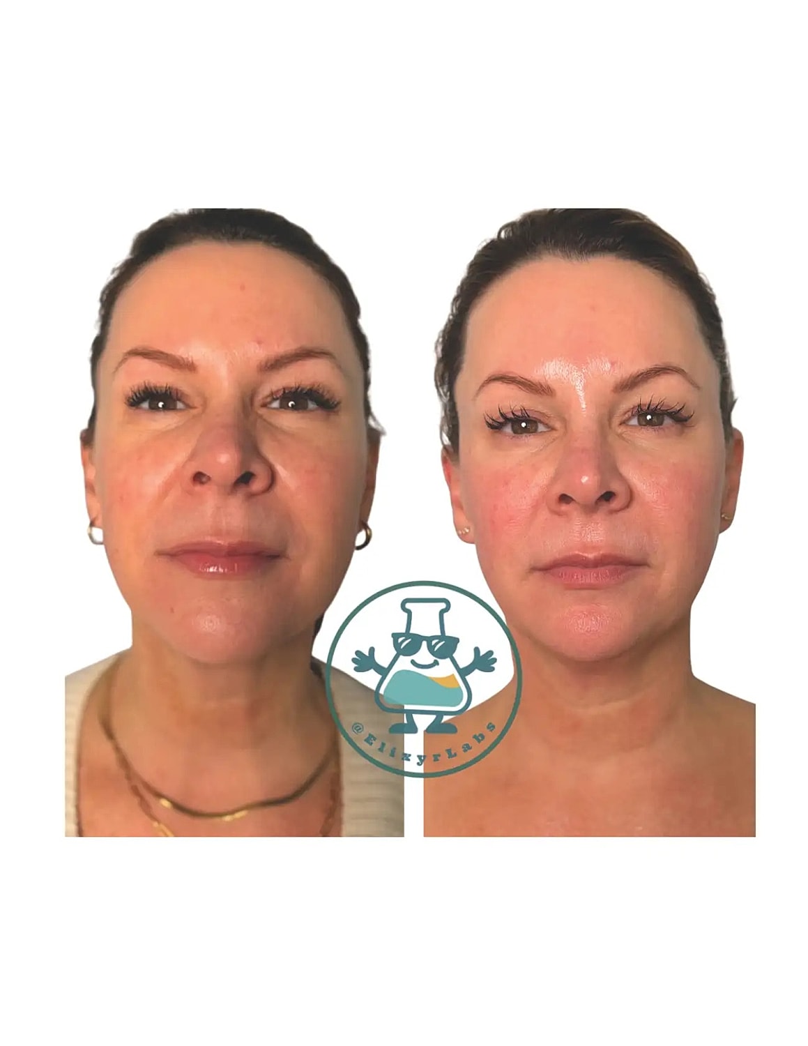 T Shape Before & After