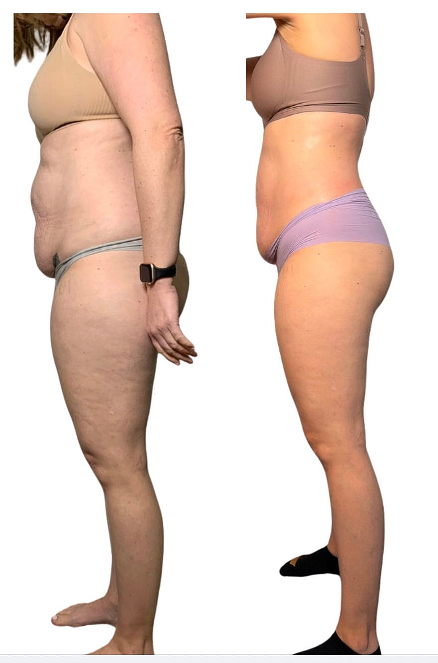 Before and after body transformation comparison side view.