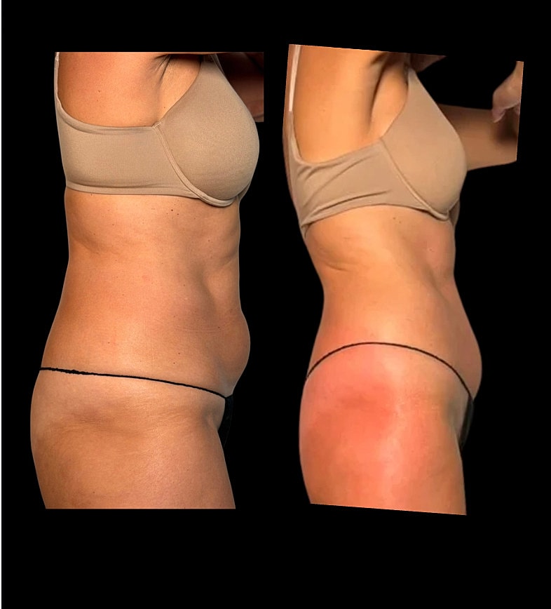Before and after body contouring comparison image.