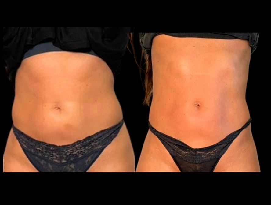 Comparison of two abdominal areas side by side.