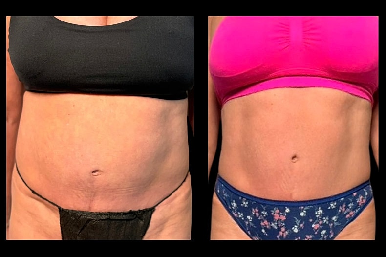 Before and after body transformation comparison.