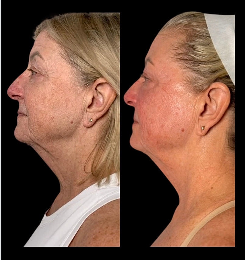 Before and after facelift comparison image.
