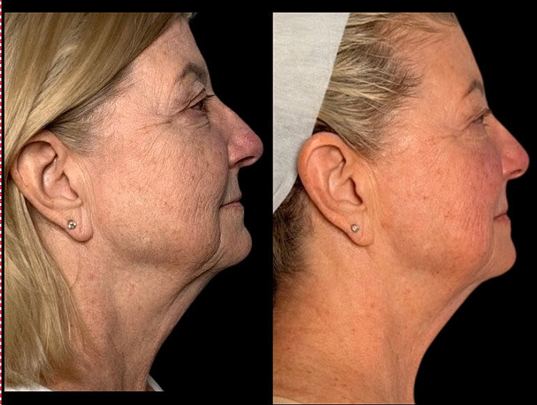 Side profile before and after facial treatment.