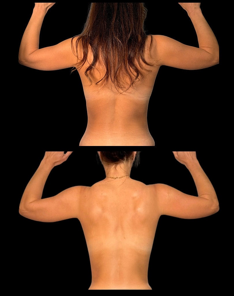 Comparison of two bare backs with raised arms.