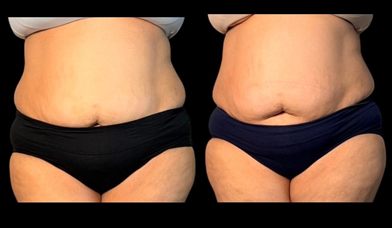 Before and after body image comparison.